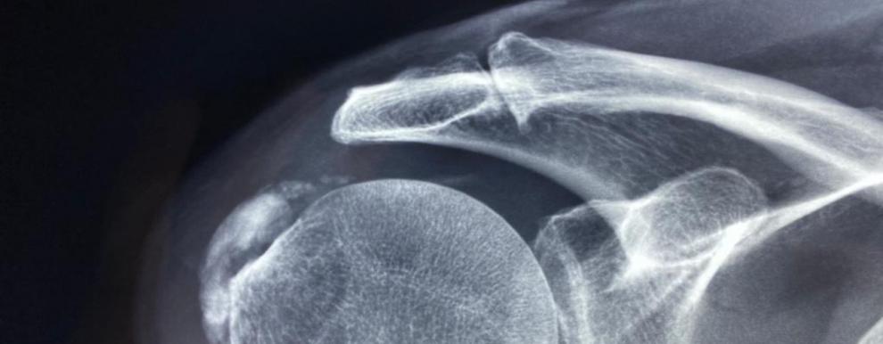 Tendinopata Calcificante: tratamiento con Ondas de Choque - Foto
