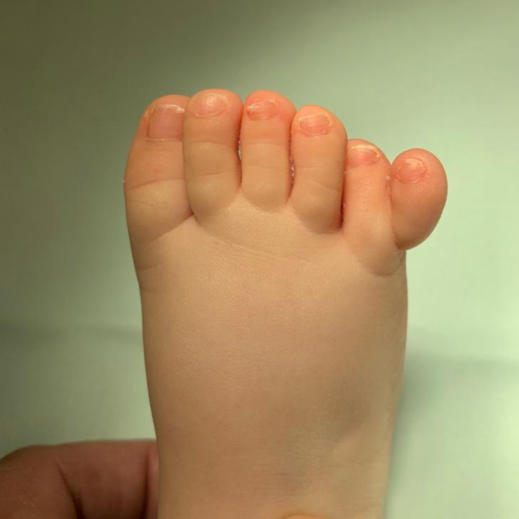 Polidactilia 